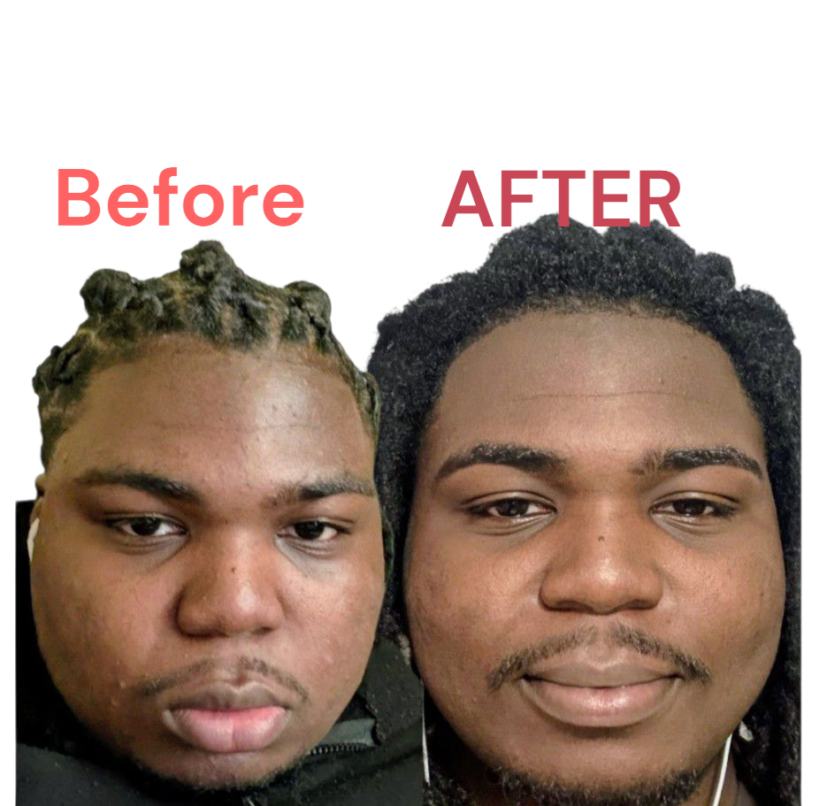 Skin lessions. Like Eczema, psoriasis 4.OZ